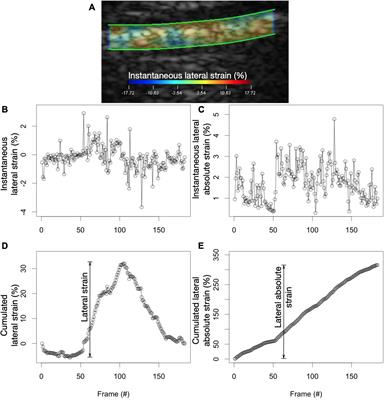 Regional pleural strain measurements during mechanical ventilation using ultrasound elastography: A randomized, crossover, proof of concept physiologic study